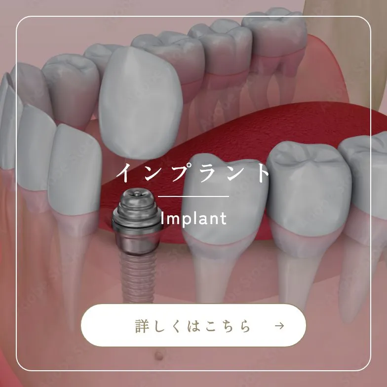 錦糸町の歯医者・歯科|ホワイトデンタルクリニック錦糸町のインプラント