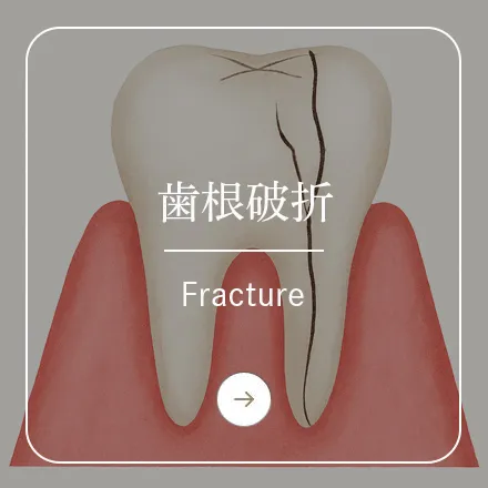錦糸町の歯医者・歯科|ホワイトデンタルクリニック錦糸町の歯根破折