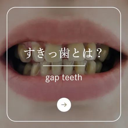 錦糸町の歯医者・歯科|ホワイトデンタルクリニック錦糸町のすきっ歯とは?